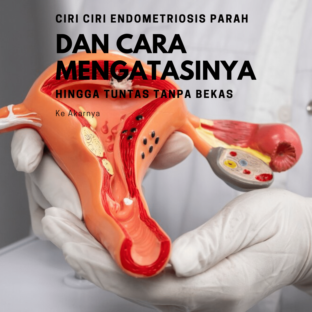 Ciri CIRI Endometriosis parah Dan Cara Mengatasinya